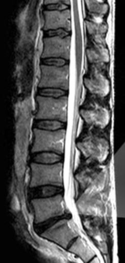 sciaitca pain relief